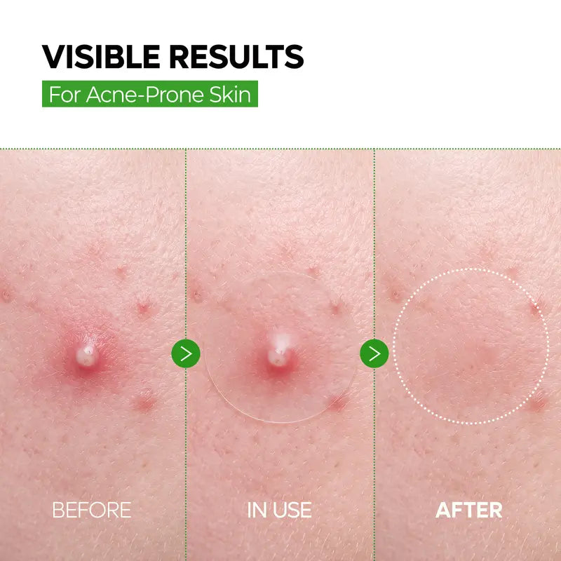 Ultra-Thin Invisible Blemish Patches – Seamless Under Makeup | 72 Count